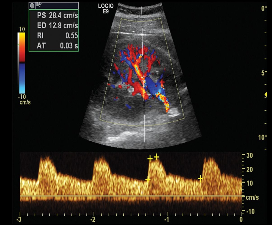 RENAL ARTERY DOPPLER