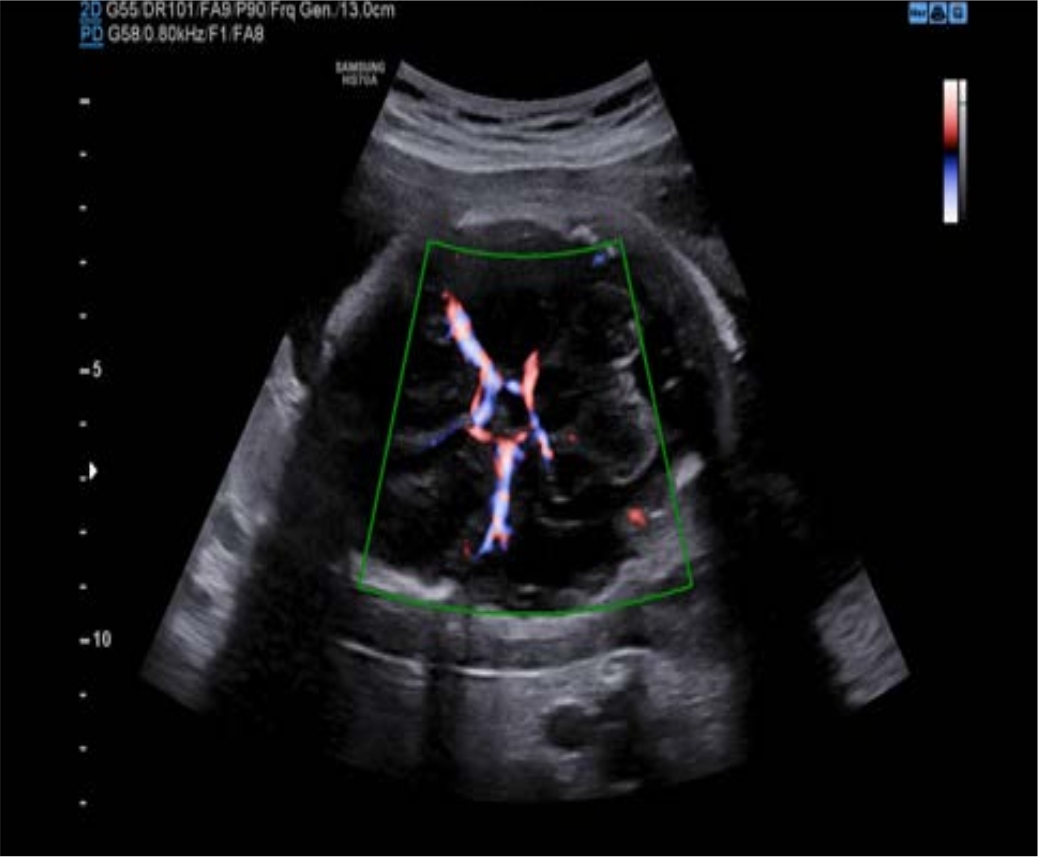 FETAL BRAIN WITH F-SLOW™