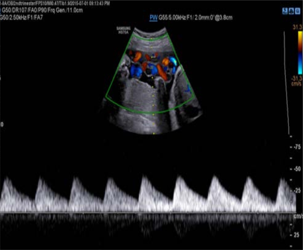 UMBILICAL ARTERY WITH PW
